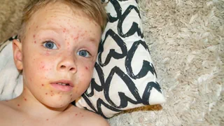 Neuer Bericht der WHO – Wegen Impfskepsis – Masern kehren zurück