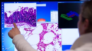 Neue Studie – Immer mehr Junge erkranken an Darmkrebs