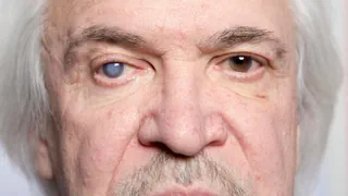 Vorsicht, Kostenfalle! – Augen auf vor der Operation des Grauen Stars