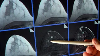 Behandlung von Brustkrebs – Gentest könnte noch mehr Menschen die Chemotherapie ersparen