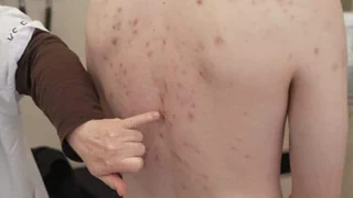 Mythen rund um Akne – Akne: Was wirklich hilft und was nicht