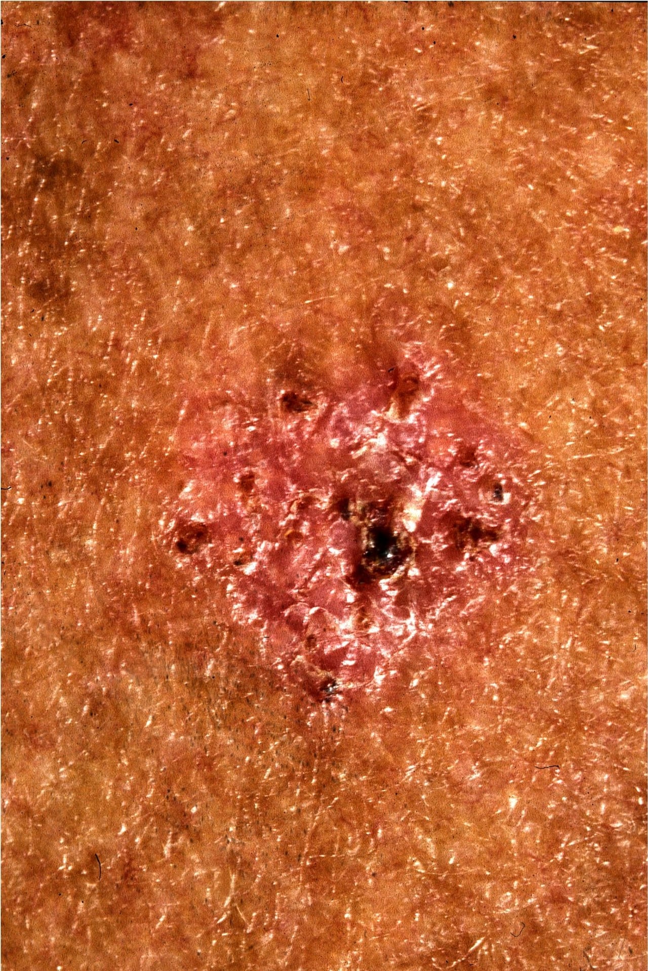 Verdächtige Hautveränderung Weisser Hautkrebs tarnt sich gut Wissen SRF