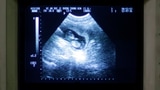 Abtreibungsfinanzierung spaltet CVP-Frauen