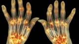 Video «Rheumatoide Arthritis, gekappte Fingerspitze, Melanom-App» abspielen