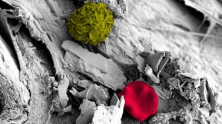Ablagerungen auf Kathetern: Kalziumkristalle, Biofilm, Bakterien, Blutkörperchen (rot) und Immunzellen (grün). Ablagerungen auf Kathetern: Kalziumkristalle, Biofilm, Bakterien, Blutkörperchen (rot) und Immunzellen (grün).