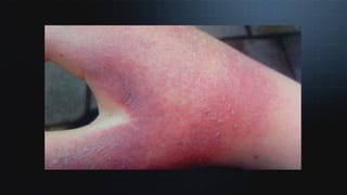 Stark gerötete Hand. Stark gerötete Hand.