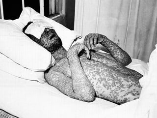 Schwarzweissaufnahme eines Mannes mit Pocken in einem Spitalbett.