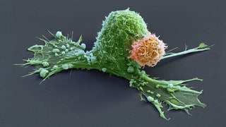 Mikroskopaufnahme einer Krebszelle und einer Immunzelle.