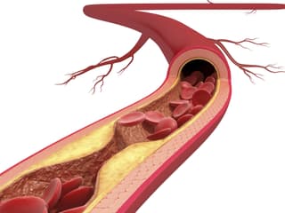 Grafik einer Arterie mit Ablagerungen.