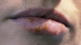 Herpes wie lange bleibt wie lange