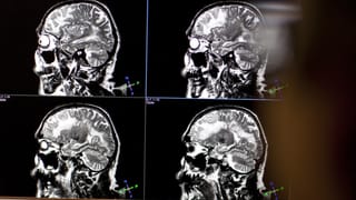 MRI eines Gehirns