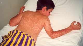 Junge mit Masern liegt auf dem Bett Junge mit Masern liegt auf dem Bett