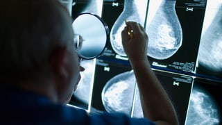 Ein Arzt untersucht das Röntgenbild einer Brustkrebspatientin