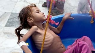 Extrem mageres Mädchen, Rippen stehen hervor, die Arme dünn wie Streichhölzer. Extrem mageres Mädchen, Rippen stehen hervor, die Arme dünn wie Streichhölzer.
