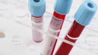 Drei Blutproben zur Bestimmung des HI-Virus.