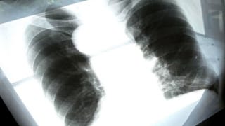 Röntgenbild einer von Asbest geschädigten Lunge.