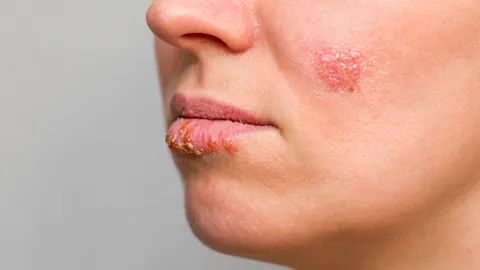 Lippenherpes