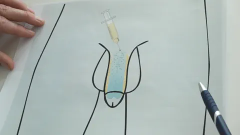 Schematische Darstellung eines Penis und wo das Fett eingespritzt wird. 