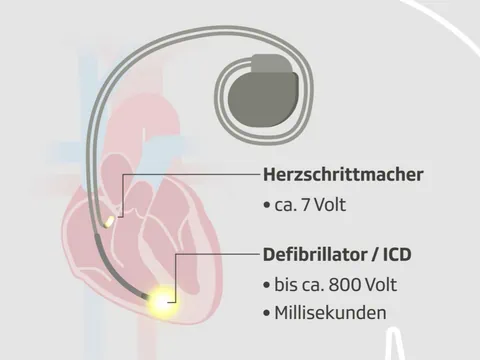 Eine Grafik mit einem Herz, Herzschrittmacher und Defibrillator.