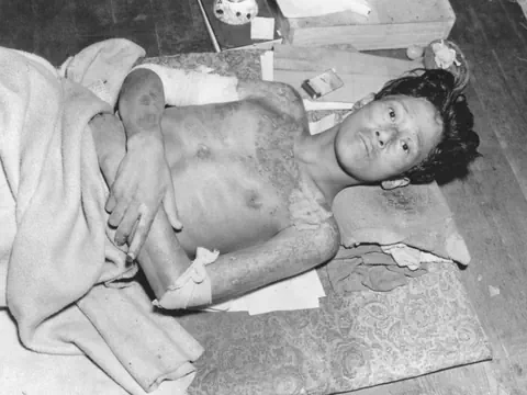Ein Überlebender der Atombombe auf Nagasaki.