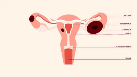 Grafik der Gebärmutter mit Endometriose.