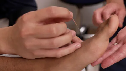 Akupunkturnadel wird in einen Fuss gesteckt.