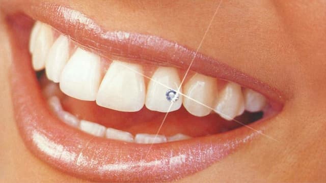 Strassstein-Mania – nicht einmal der Mund wurde verschont. Strassstein-Mania – nicht einmal der Mund wurde verschont.