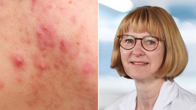 Bildmontage: Hautausschlag und Porträt von Bildmontage: Hautausschlag und Porträt von