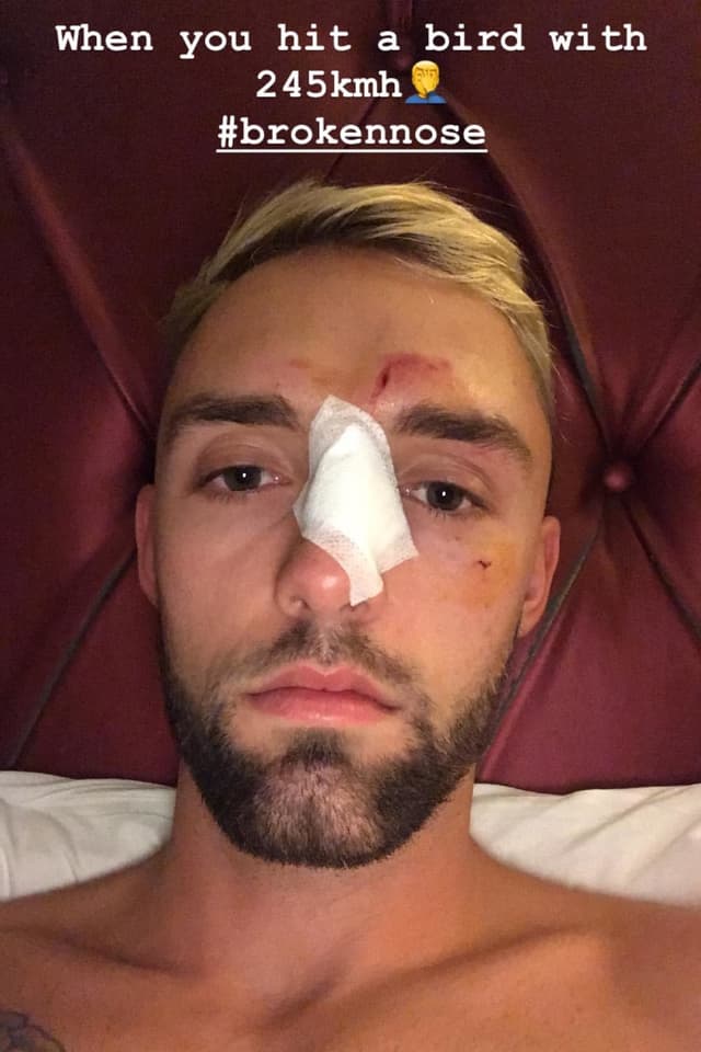 Jonas Folger liess sich mit Gesichtswunden ablichten. Jonas Folger liess sich mit Gesichtswunden ablichten.