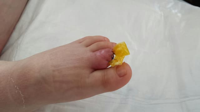 Kinderfuss mit einem abgetrennten Zeh. Kinderfuss mit einem abgetrennten Zeh.