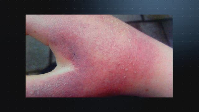 Stark gerötete Hand. Stark gerötete Hand.