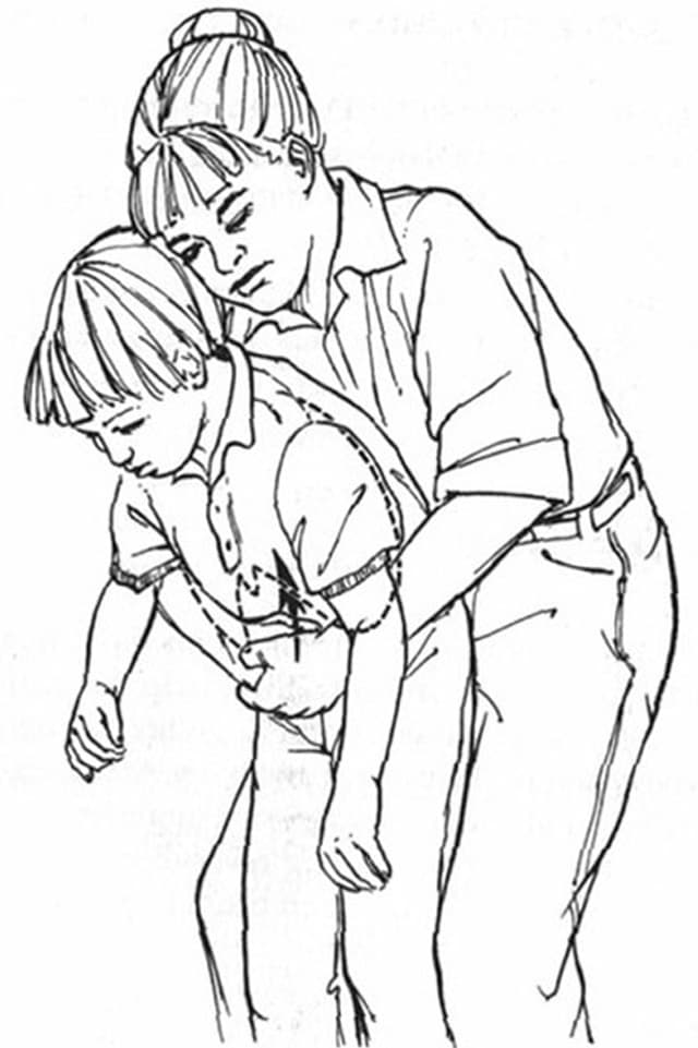 «Heimlich-Manöver» «Heimlich-Manöver»