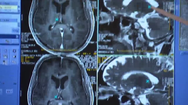 Video «Ultraschall gegen Hirntumor» abspielen Video «Ultraschall gegen Hirntumor» abspielen