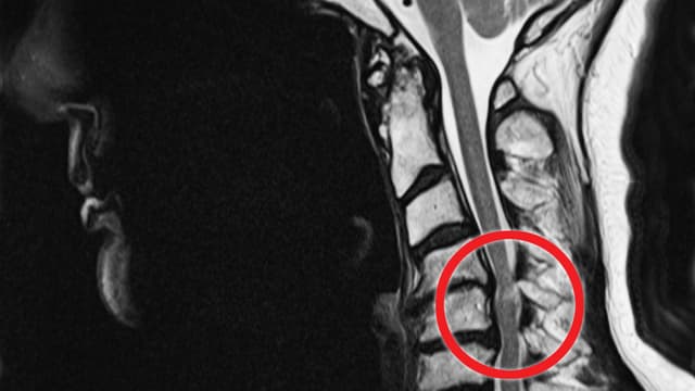 MRI mit gequetschtem Rückenmark MRI mit gequetschtem Rückenmark