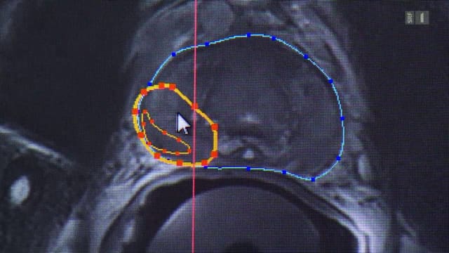 puls srf prostata puls srf prostata