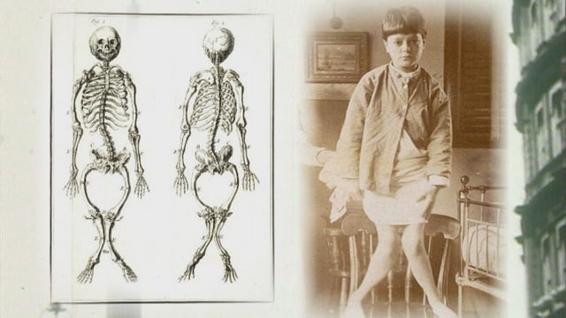Kind mit extremen X-Beinen, daneben eine Zeichnung des verformten Skeletts Kind mit extremen X-Beinen, daneben eine Zeichnung des verformten Skeletts