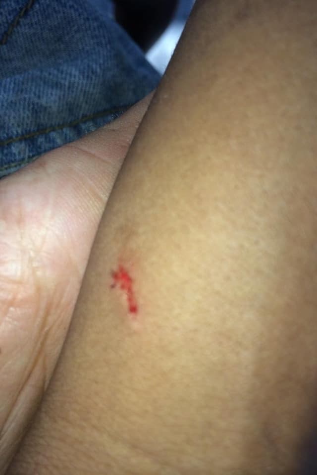 Nahaufnahme einer blutenden Wunde am Arm. Nahaufnahme einer blutenden Wunde am Arm.