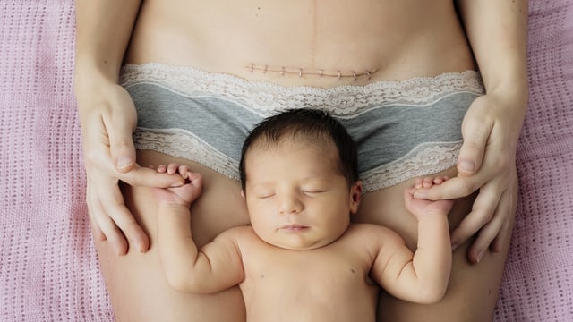 Frauenbauch mit Kaiserschnittnarbe ein einem daruf liegenden Baby.