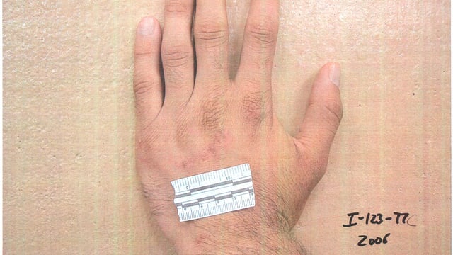 Hand mit kleiner Wunde und Zentimetermassstab Hand mit kleiner Wunde und Zentimetermassstab