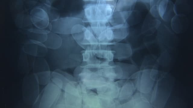 Ein Röntgenbild zeigt Drogen-Päckchen im Körper Ein Röntgenbild zeigt Drogen-Päckchen im Körper