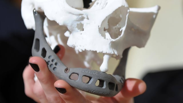 Kieferimplantat. Kieferimplantat.