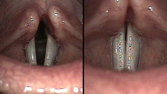 Markoaufnahmen von Stimmlippen im menschlichen Hals Markoaufnahmen von Stimmlippen im menschlichen Hals