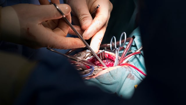 Blick auf eine Herzoperation: Klammern, Schläuche und zwei Hände in Operationshandschuhen.