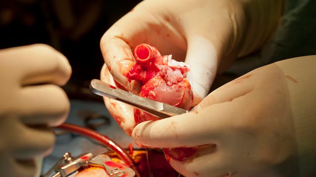 Ein Chirurg hält ein Herz in seinen Händen.