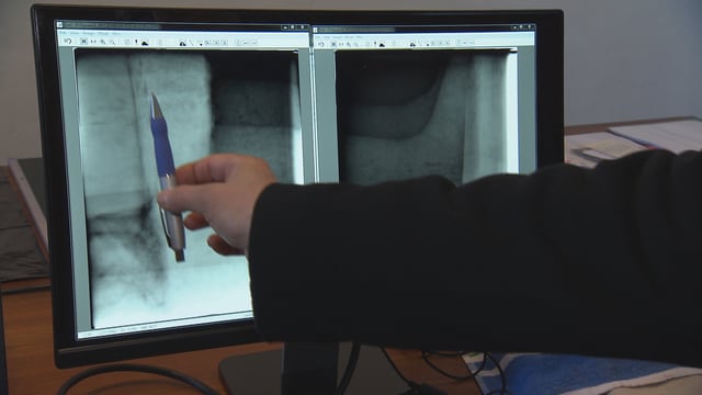 Ein Kugelschreiber zeigt auf ein Röntgenbild auf einem Computerbildschirm.