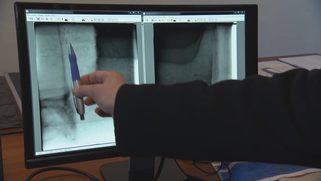Ein Kugelschreiber zeigt auf ein Röntgenbild auf einem Computerbildschirm. Ein Kugelschreiber zeigt auf ein Röntgenbild auf einem Computerbildschirm.