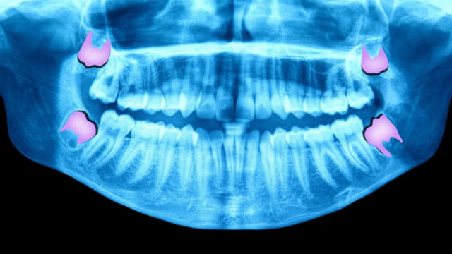 Röntgenaufnahme des Kiefers mit Weisheitszähnen.