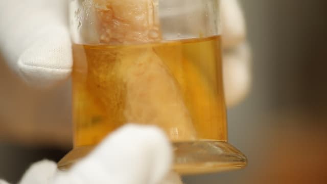 Ein Glas mit menschlichem Fett in gelber Flüssigkeit. Ein Glas mit menschlichem Fett in gelber Flüssigkeit.