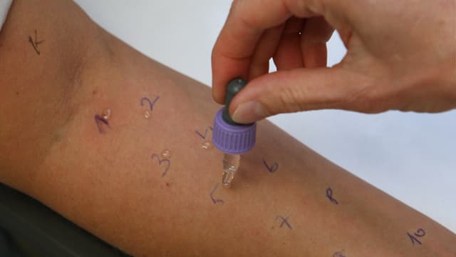 Ein Arzt nimmt am Arm einer Patientin einen Allergietest vor. 