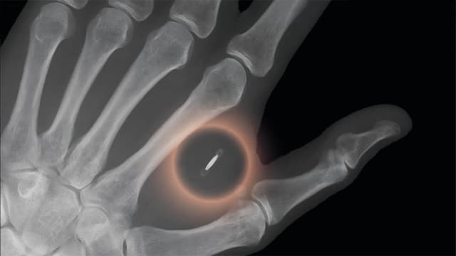 Röntgenbild Hand mit Chip Röntgenbild Hand mit Chip